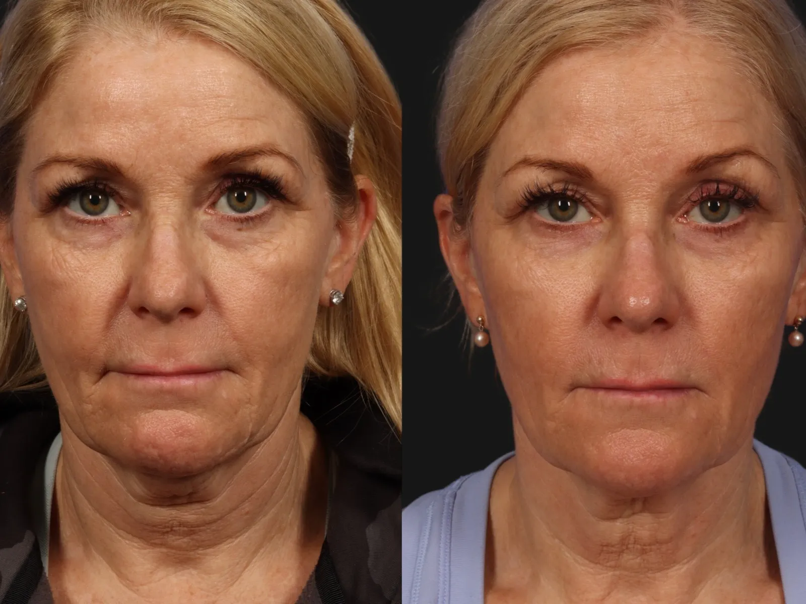 Morpheus8 Results